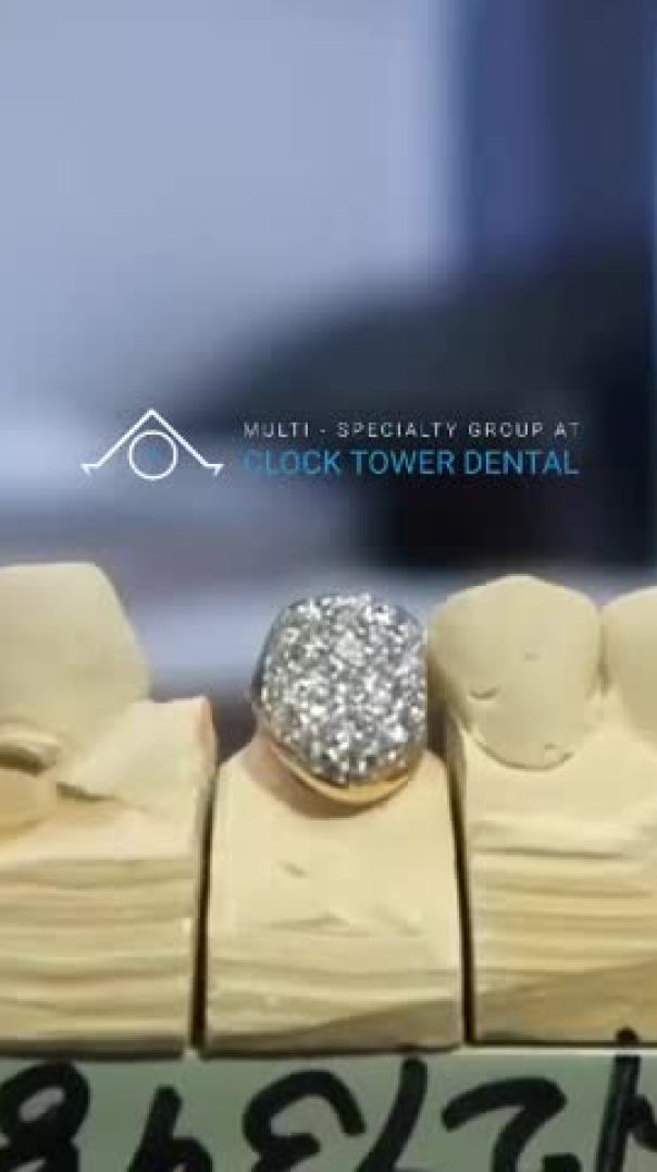 VSS Chandelier Diamond  Grillz Dental Gold Crown