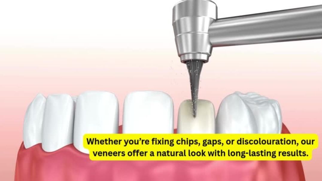 Dental Veneers Willoughby