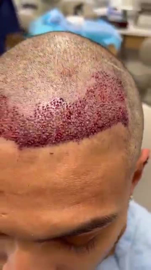 Linkov Hair Surgery