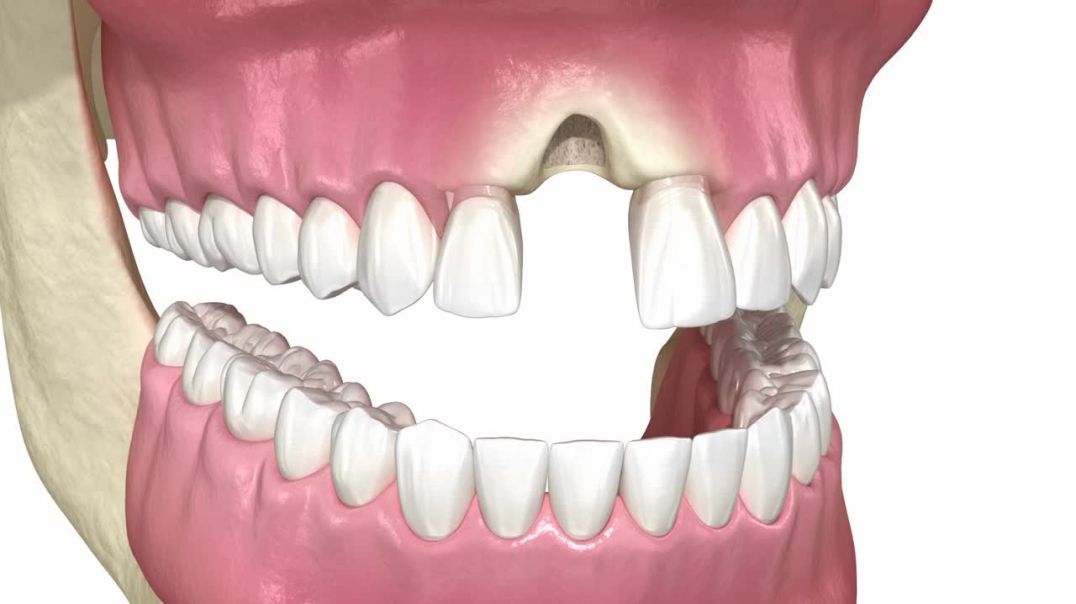 Socket Preservation (3D Animation)