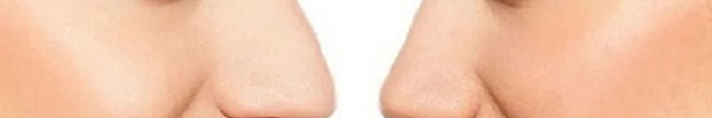 La rinoplastica in Ospedale