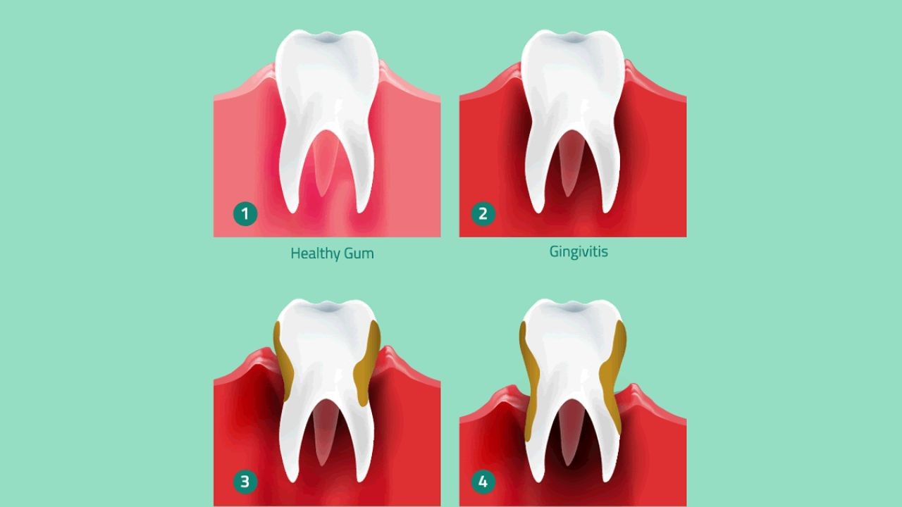 The Link Between Gum Disease & Heart Disease (What Science Says) – The Future of Innovation in New Zealand