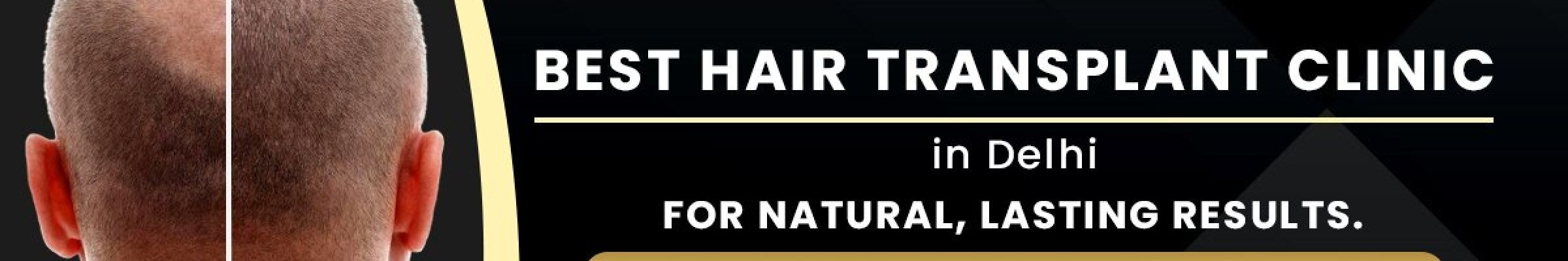Hair Transplant